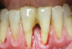 Denti e gengive: i danni del fumo