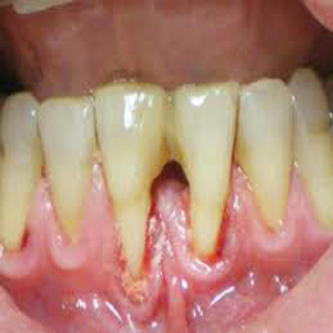 Denti e gengive: i danni del fumo