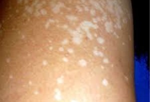 Macchie bianche sulla pelle: come rimediare naturalmente?