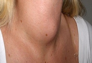 Gozzo tiroideo: sintomi, diagnosi e definizione