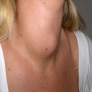 Gozzo tiroideo: sintomi, diagnosi e definizione