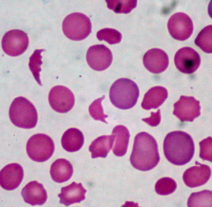 anemia emolitica