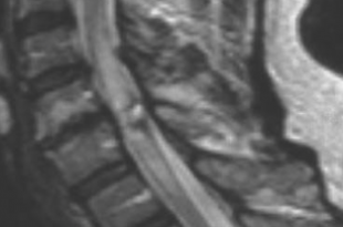 angioma vertebrale