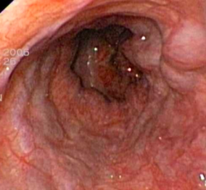 varici esofagee