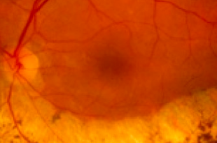 retinite pigmentosa