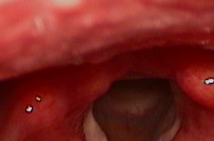 edema corde vocali
