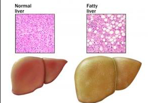 fegato grasso