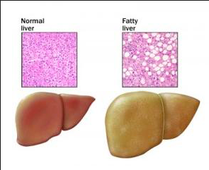 fegato grasso