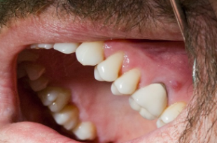 granuloma dentale