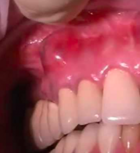 ascesso dentale