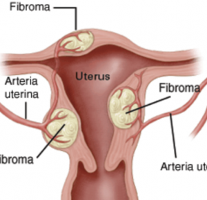fibroma utero