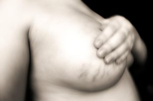 smagliature seno gravidanza