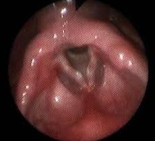 noduli corde vocali