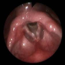 noduli corde vocali