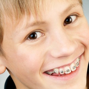 apparecchi ai denti