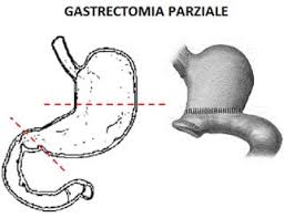 Gastrectomia parziale