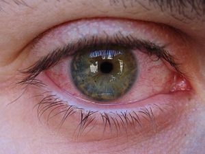 Si possono usare le lenti a contatto con l'allergia?