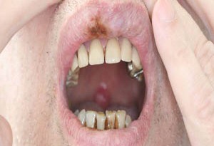 Cavo orale: tutti i danni del fumo