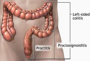 proctitis