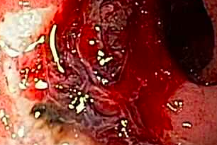 ulcera peptica