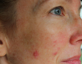 acne menopausa