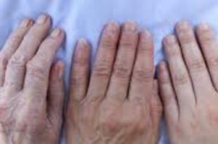 artrite e artrosi