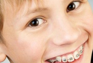 apparecchi ai denti