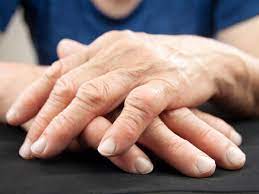 sintomi artrite e artrosi