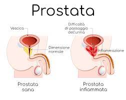 prostata malata