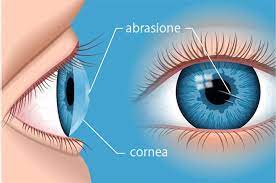 abrasione corneale